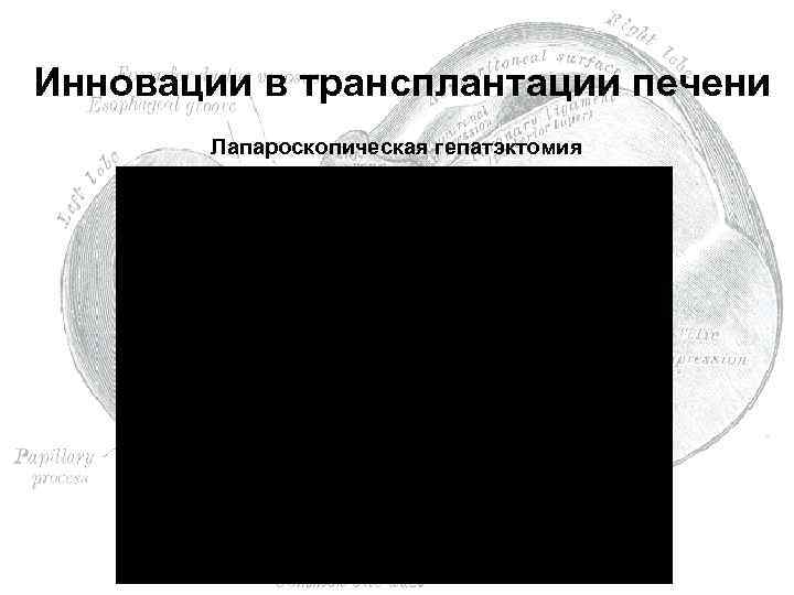  Инновации в трансплантации печени Лапароскопическая гепатэктомия 