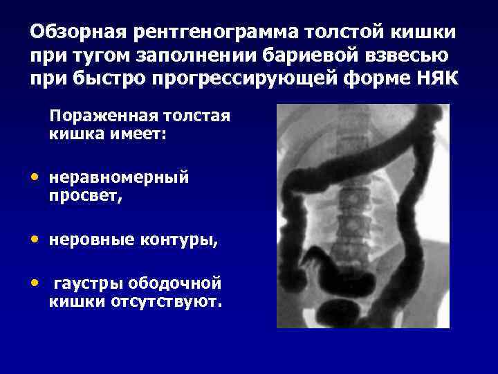 Обзорная рентгенограмма толстой кишки при тугом заполнении бариевой взвесью при быстро прогрессирующей форме НЯК