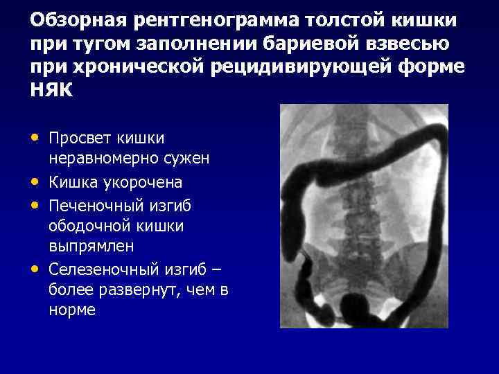 Обзорная рентгенограмма толстой кишки при тугом заполнении бариевой взвесью при хронической рецидивирующей форме НЯК