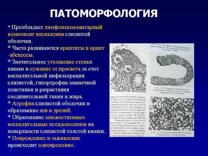 ПАТОМОРФОЛОГИЯ * Преобладает лимфоплазмоцитарный компонент воспаления слизистой оболочки. * Часто развиваются криптиты и крипт