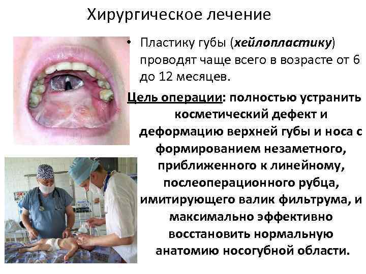 Хирургическое лечение • Пластику губы (хейлопластику) проводят чаще всего в возрасте от 6 до