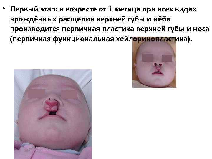  • Первый этап: в возрасте от 1 месяца при всех видах врождённых расщелин