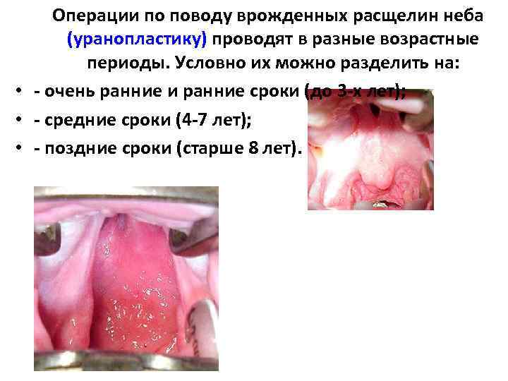 Операции по поводу врожденных расщелин неба (уранопластику) проводят в разные возрастные периоды. Условно их