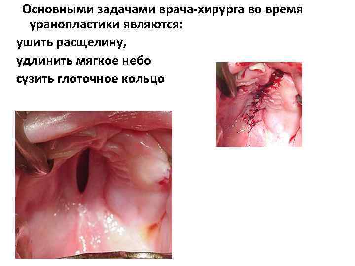 Основными задачами врача-хирурга во время уранопластики являются: ушить расщелину, удлинить мягкое небо сузить глоточное