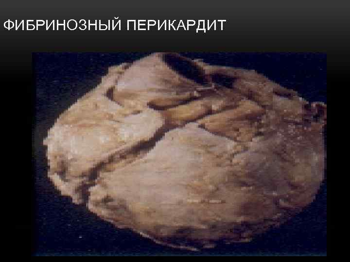 ФИБРИНОЗНЫЙ ПЕРИКАРДИТ 