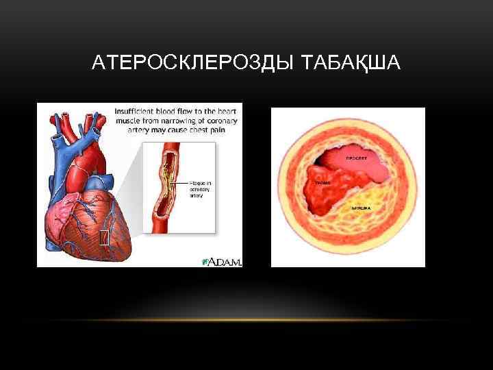 АТЕРОСКЛЕРОЗДЫ ТАБАҚША 