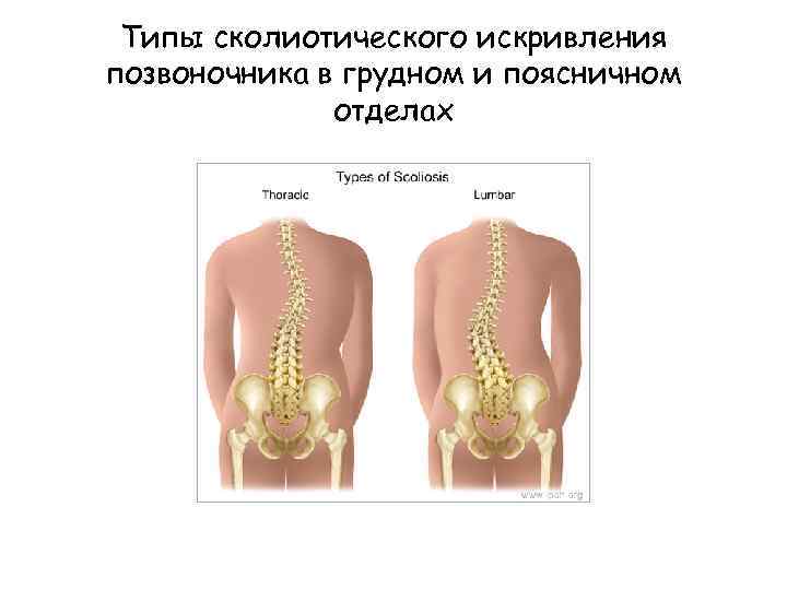 Типы сколиотического искривления позвоночника в грудном и поясничном отделах 