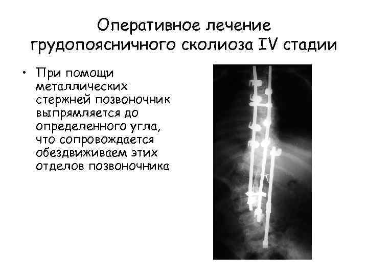 Оперативное лечение грудопоясничного сколиоза IV стадии • При помощи металлических стержней позвоночник выпрямляется до