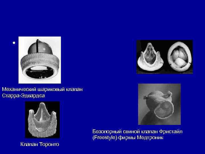  • Механический шариковый клапан Старра Эдвардса Безопорный свиной клапан Фристайл (Freestyle) фирмы Медтроник