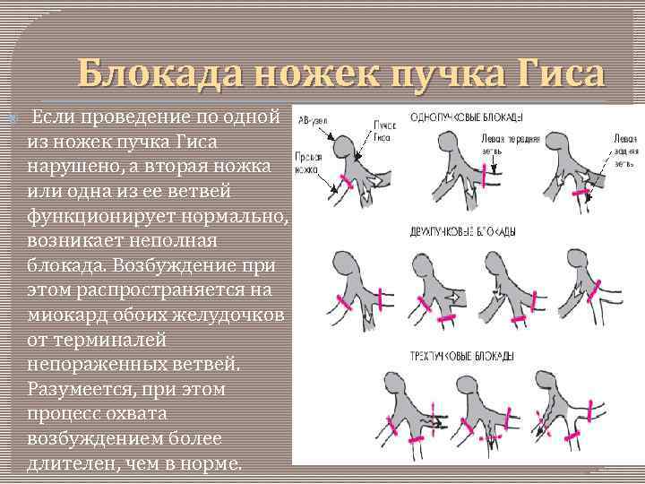 Блокада ножек пучка Гиса Если проведение по одной из ножек пучка Гиса нарушено, а