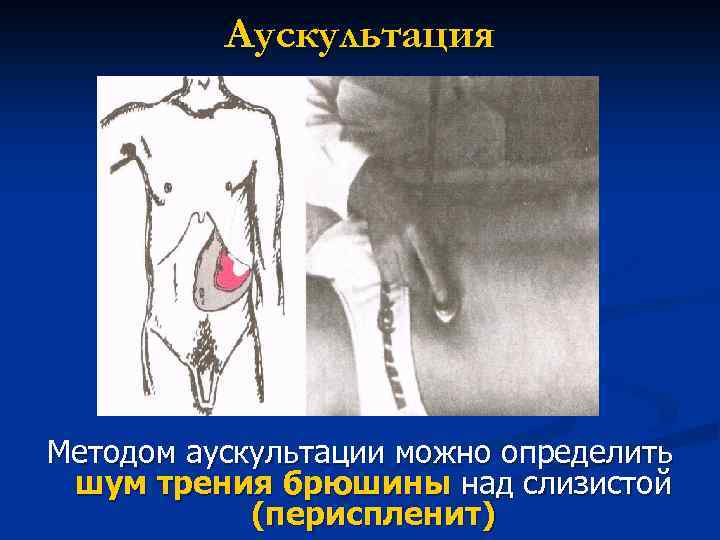 Аускультация Методом аускультации можно определить шум трения брюшины над слизистой (периспленит) 