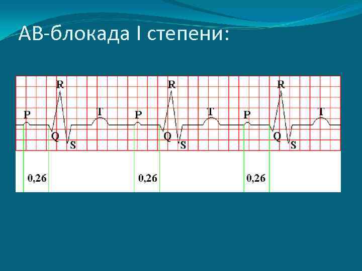 Ав блокада 1. АВ блокада 1 степени. Преходящая av блокада 1 степени. Атриовентрикулярная блокада 1 степени. Аве блокада сердца 1 степени.