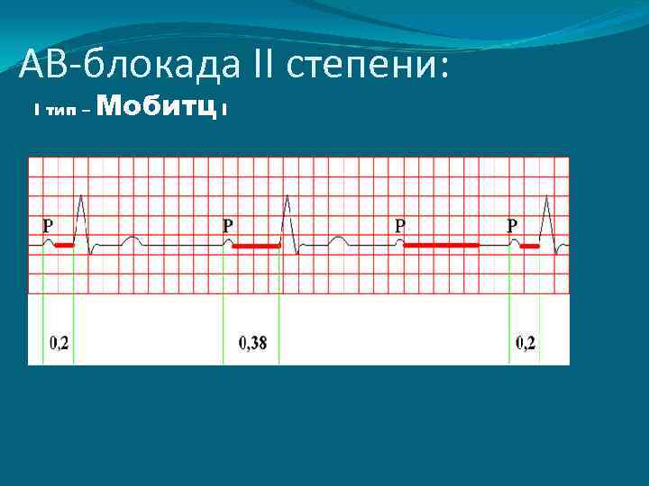 АВ-блокада II степени: I тип – Мобитц I 