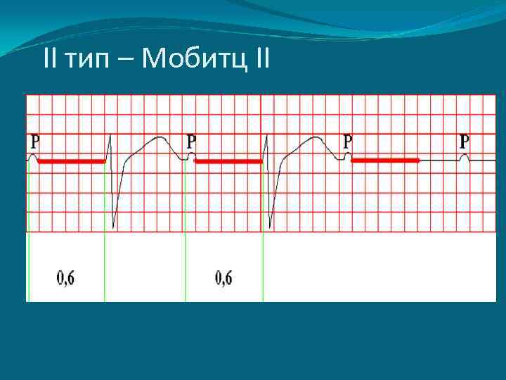 II тип – Мобитц II 