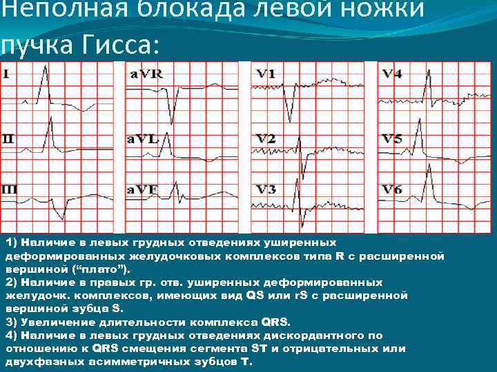 Неполная блокада левой ножки пучка Гисса: 1) Наличие в левых грудных отведениях уширенных деформированных
