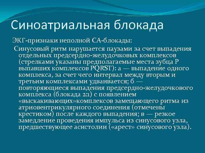 Синоатриальная блокада ЭКГ-признаки неполной СА-блокады: Синусовый ритм нарушается паузами за счет выпадения отдельных предсердно-желудочковых