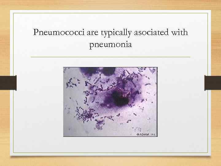 Pneumococci are typically asociated with pneumonia 