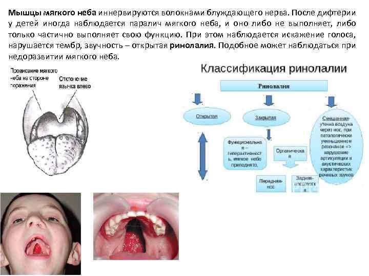 Дифтерия у детей фото горла