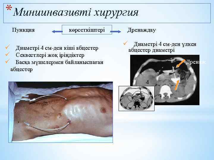*Миниинвазивті хирургия Пункция көрсеткіштері ü Диаметрі 4 см-ден кіші абцестер ü Секвестлері жоқ іріңдіктер