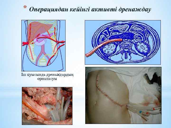 * Операциядан кейінгі активті дренаждау Іш қуысында дренаждардың орналасуы 