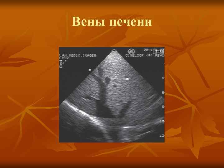 Вены печени 