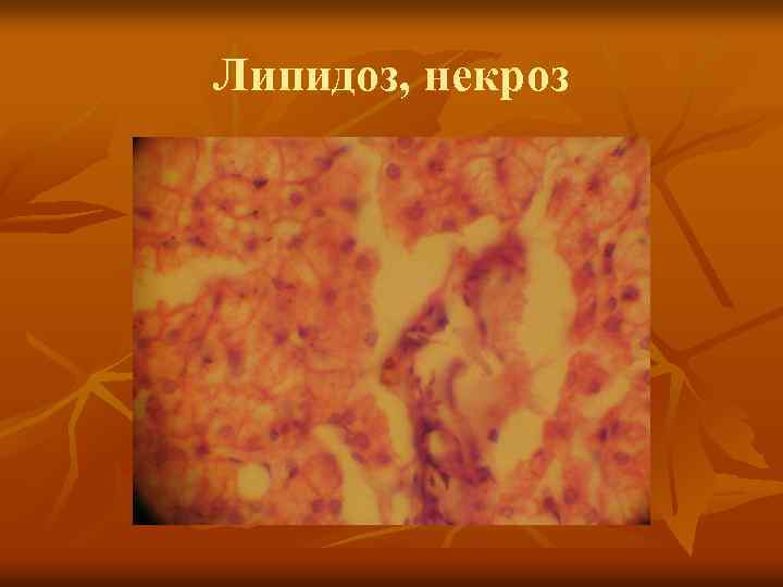 Липидоз, некроз 