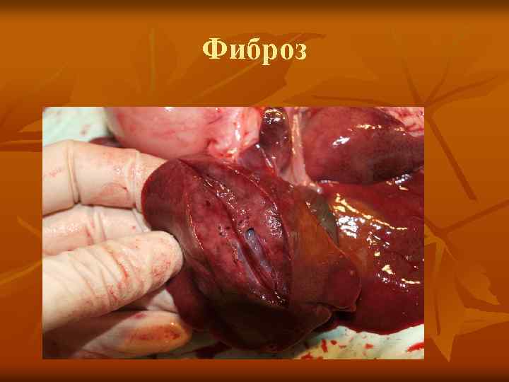 Фиброз 