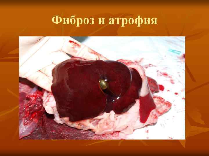 Фиброз и атрофия 