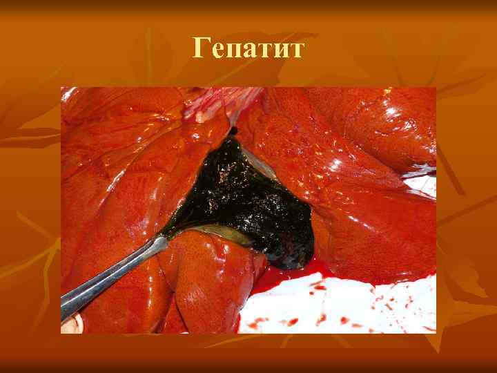 Гепатит 