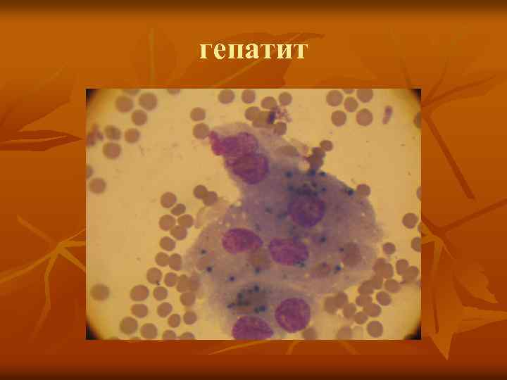 гепатит 
