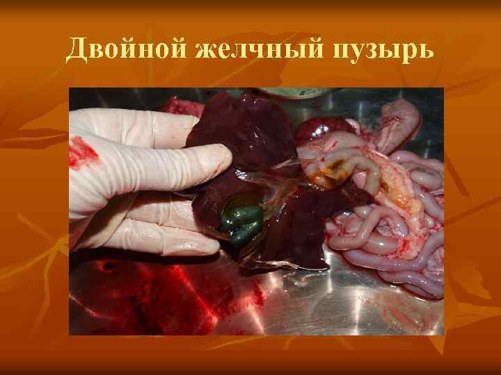 Двойной желчный пузырь 