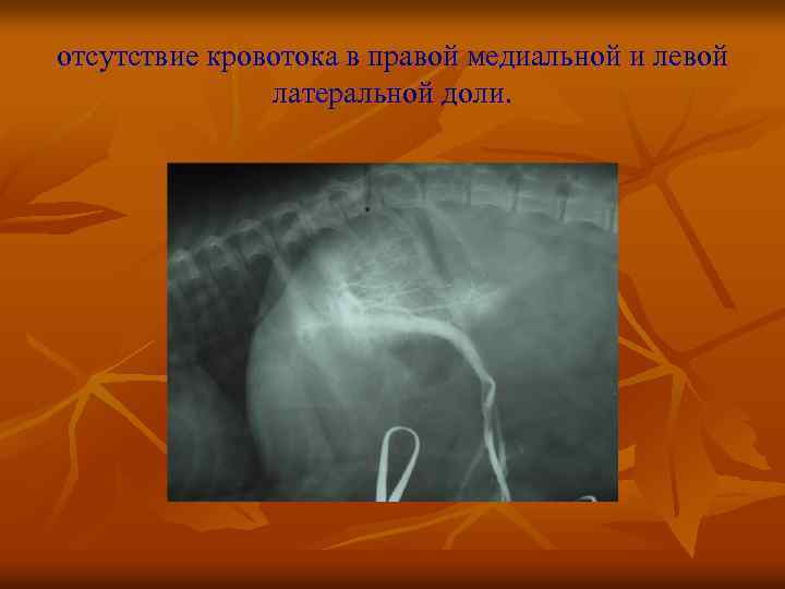 отсутствие кровотока в правой медиальной и левой латеральной доли. 
