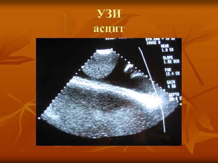 УЗИ асцит 