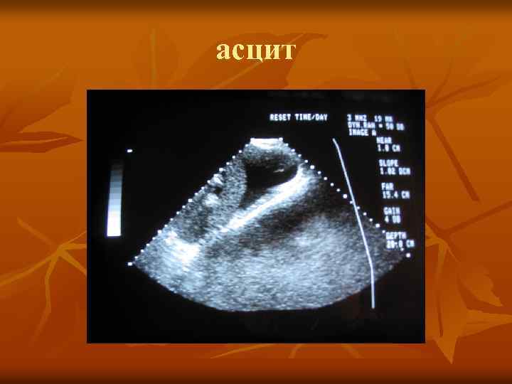 асцит 