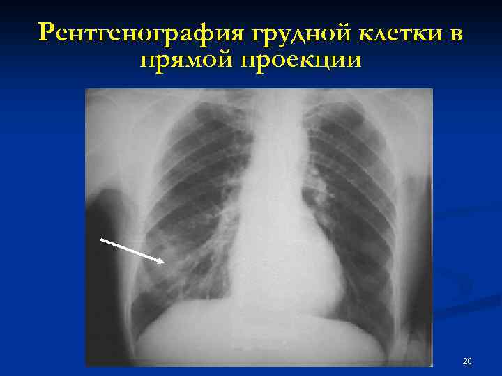 Рентгенография грудной клетки в прямой проекции 20 