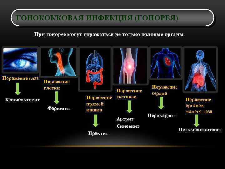 ГОНОКОККОВАЯ ИНФЕКЦИЯ (ГОНОРЕЯ) При гонорее могут поражаться не только половые органы Поражение глаз Поражение