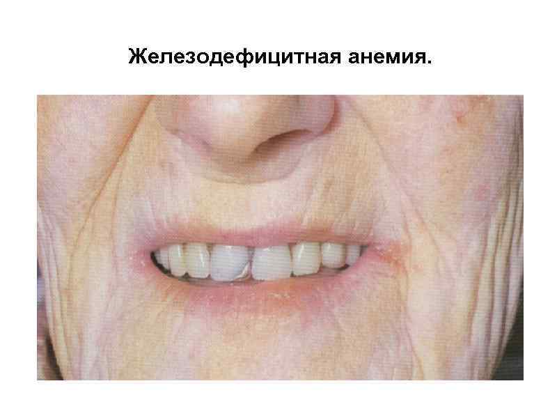 Железодефицитная анемия. 