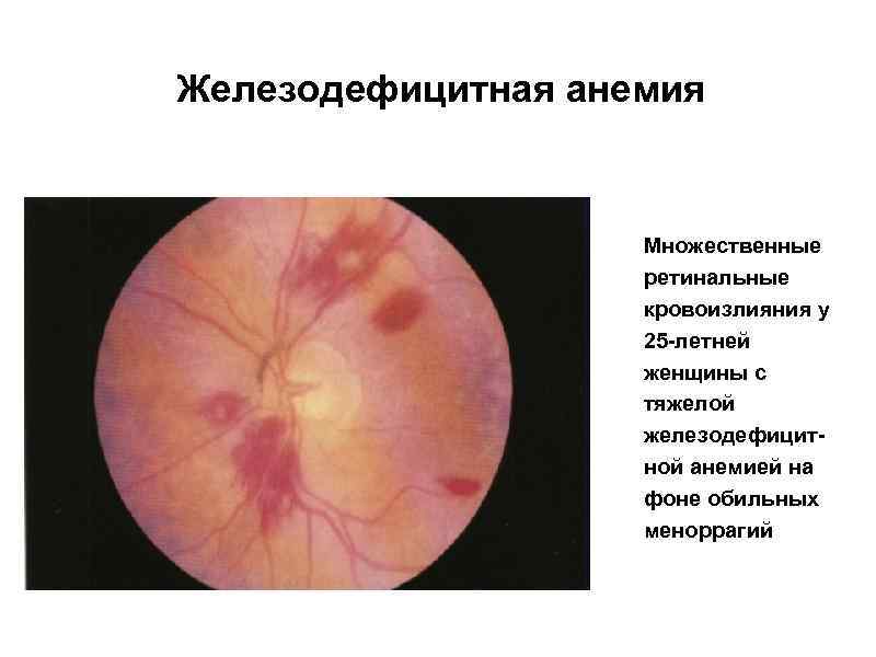 Железодефицитная анемия Множественные ретинальные кровоизлияния у 25 -летней женщины с тяжелой железодефицитной анемией на