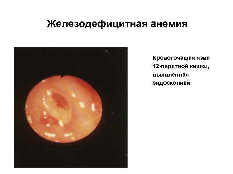 Железодефицитная анемия Кровоточащая язва 12 -перстной кишки, выявленная эндоскопией 