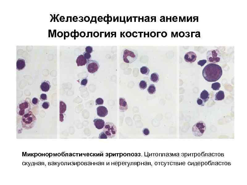 Железодефицитная анемия Морфология костного мозга Микронормобластический эритропоэз. Цитоплазма эритробластов скудная, вакуолизированная и нерегулярная, отсутствие