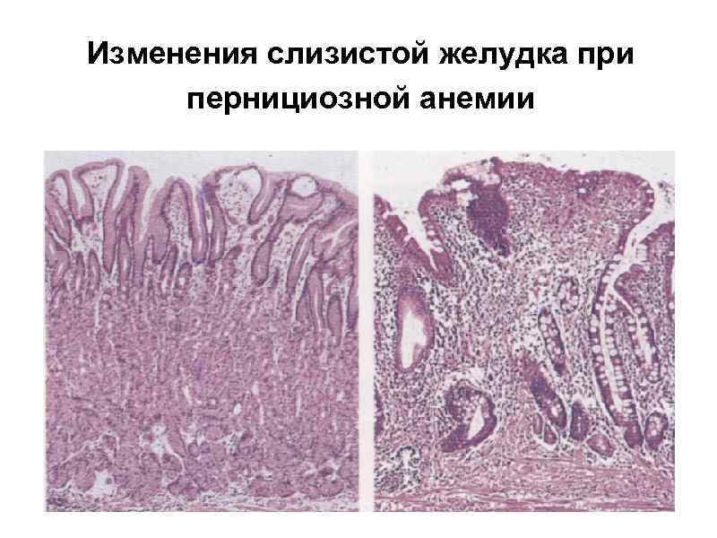 Изменения слизистой желудка при пернициозной анемии 