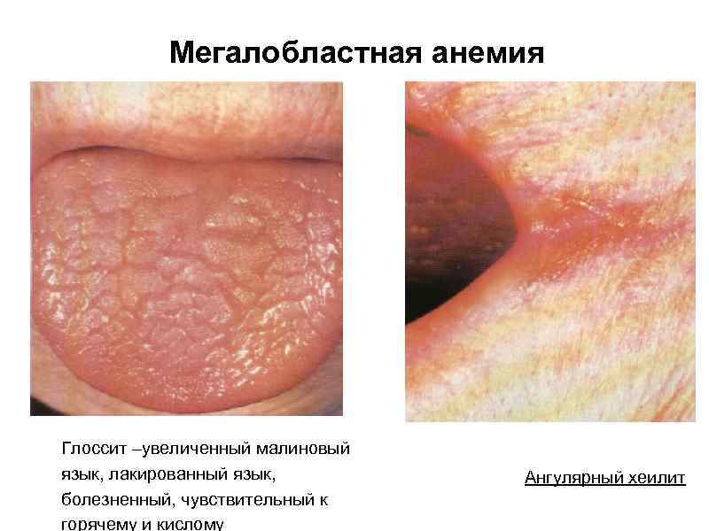 Мегалобластная анемия Глоссит –увеличенный малиновый язык, лакированный язык, болезненный, чувствительный к горячему и кислому