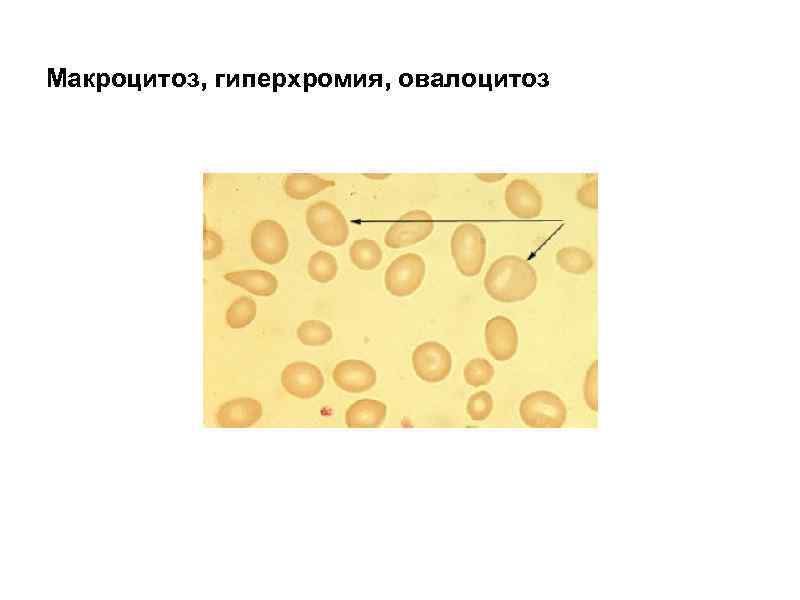 Макроцитоз, гиперхромия, овалоцитоз 