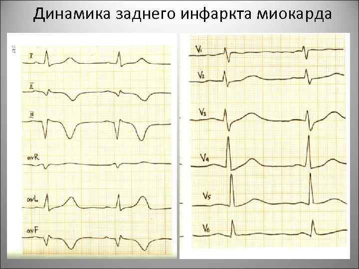 Динамика заднего инфаркта миокарда 