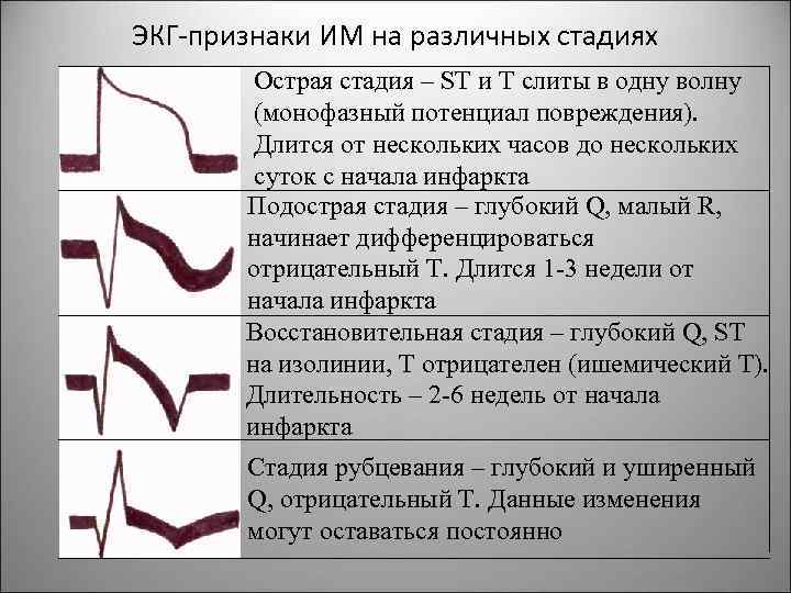 ЭКГ-признаки ИМ на различных стадиях Острая стадия – ST и T слиты в одну