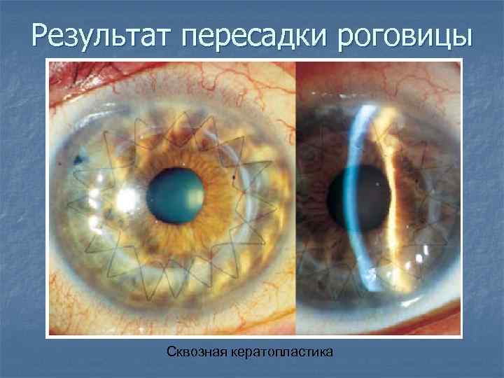 Результат пересадки роговицы Сквозная кератопластика 