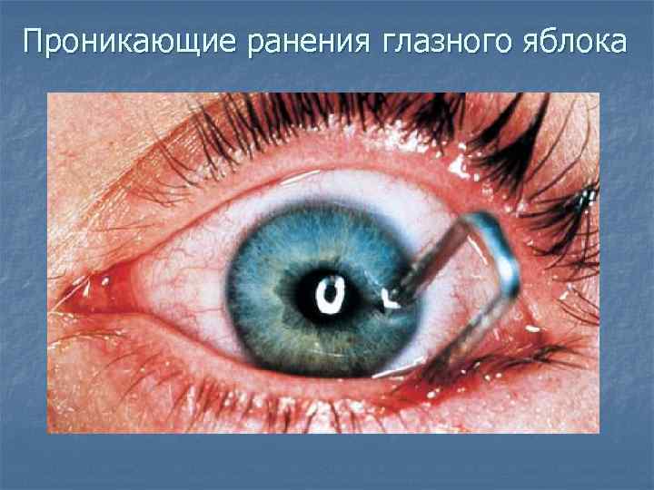 Проникающие ранения глазного яблока 