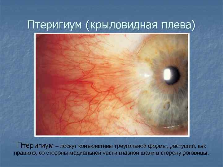 Птеригиум (крыловидная плева) Птеригиум – лоскут конъюнктивы треугольной формы, растущий, как правило, со стороны