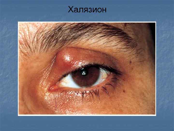 Халязион 