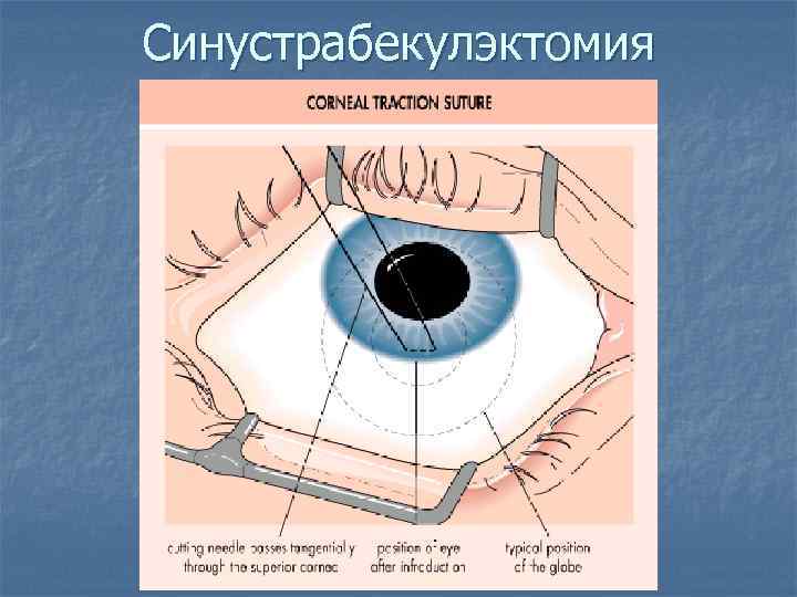 Синустрабекулэктомия 
